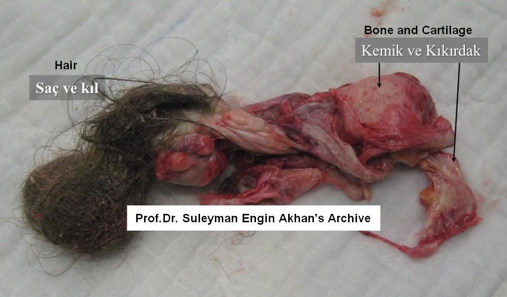 Bone, hair, and cartilage in 20 cm dermoid cyst (mature cystic teratoma)