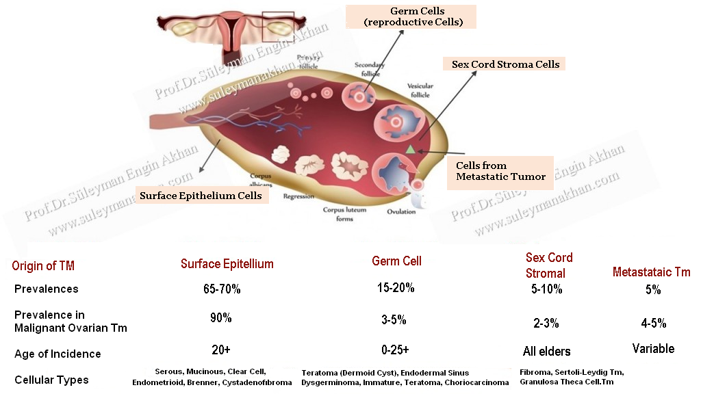 dermoid cyst ovary eye