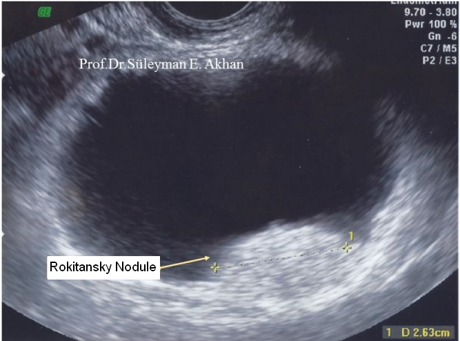 "Rokitansky nodule" on the rectal USG image of the 16-year-old girl